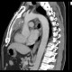 Thymoma, malignant thymoma, treatment: CT - Computed tomography